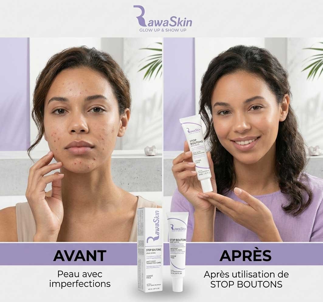 Stop Boutons - Traitement SOS Anti-Acné 